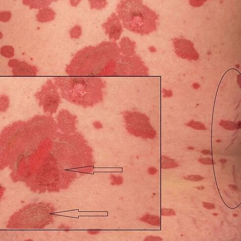 Toxic epidermal necrolysis