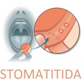 Stomatitida je zánět sliznice dutiny ústní
