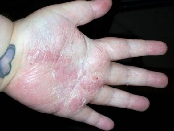 psoriáza na dlaních