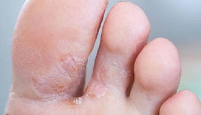 athelete's foot massage