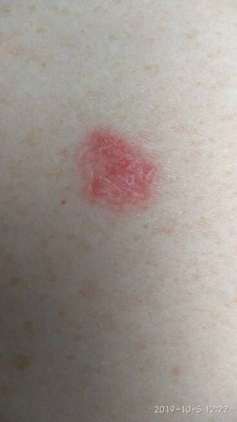 Bowen's Disease (ICD-10: D04) - Online consultation AI dermatologist