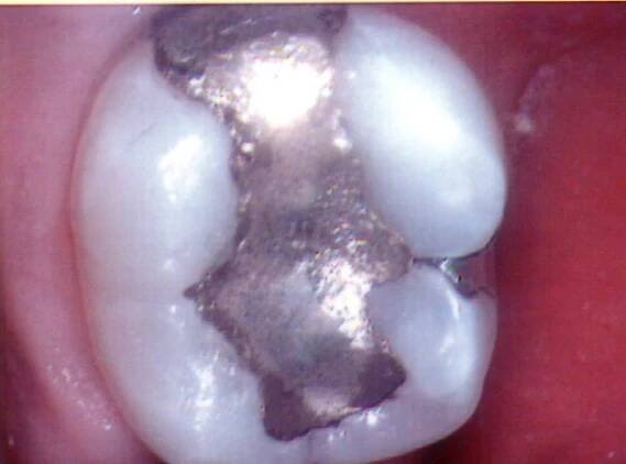 Dental amalgam
