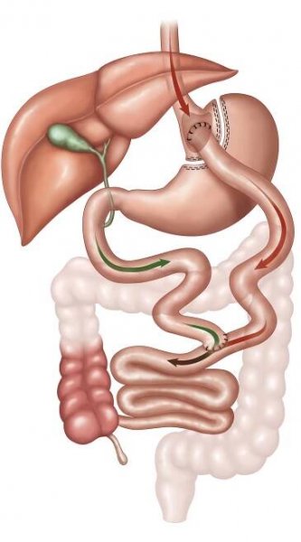 Gastric Bypass Surgery
