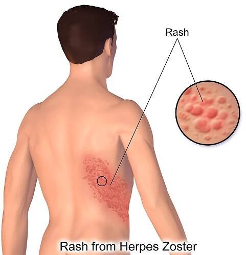 Pásový opar - léčení, přenos, příznaky, foto | ČeskoZdravě.cz