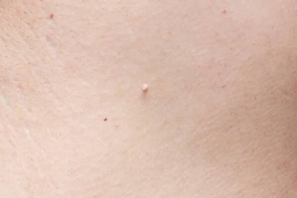 Pedunculovaná kožní značka nebo akrochondon nebo měkká fibroma. papilomu na lidské kůži. Bradavice. Dermatologický problém. Mole na těle, odstranění mol nevus nebo koncepce bradavic — Stock obrázek