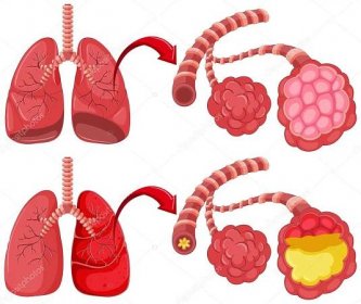 Člověka plíce zápal plic Stock Vector by ©interactimages 116840240