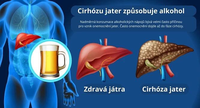 cirhóza jater a alkohol
