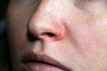cuperóza na nose mladé ženy. akné na obličeji. vyšetření lékařem - růžovka - stock snímky, obrázky a fotky