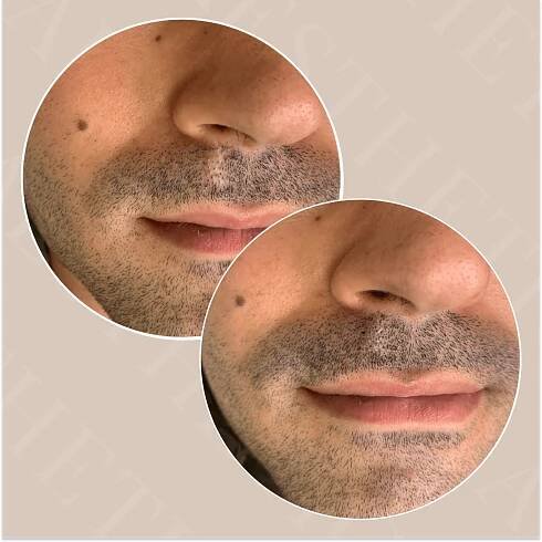Tetování vlasů Praha | Profesionální mikropigmentace | AR aesthetics