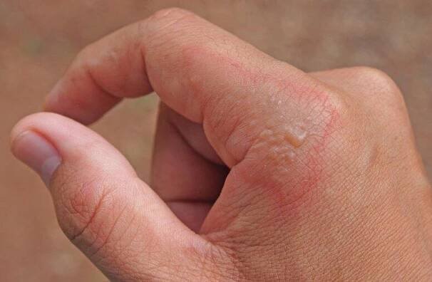 Dospělý postižený onemocněním impetigo