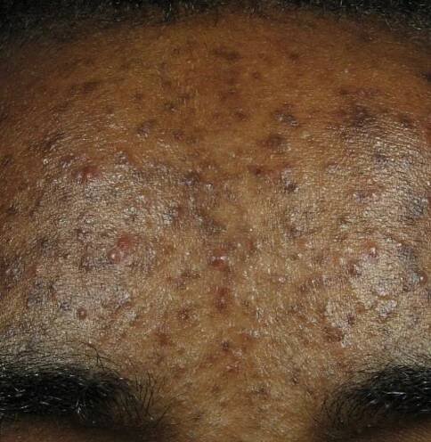 obagi treatment london before