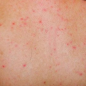 Alergická vyrážka dermatitida zpět kůže pacienta — Stock obrázek