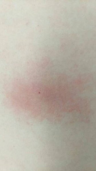 Dermatitis (ICD-10: L20-L30) - Online consultation AI dermatologist