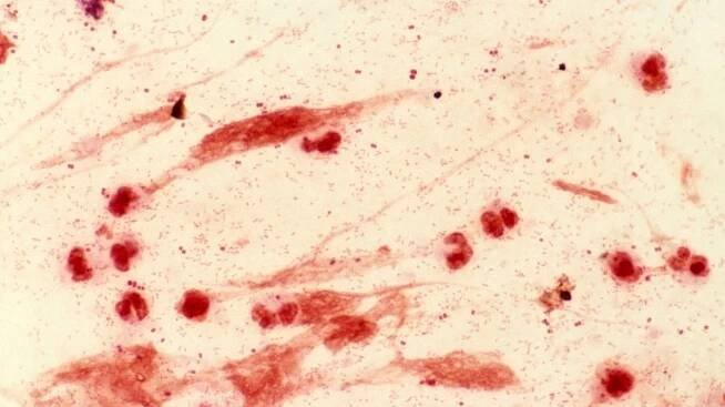 Vědci zkoumali ostatky chlapce ze 6. století. Zemřel na mor, meningitidu a septickou artritidu - Novinky