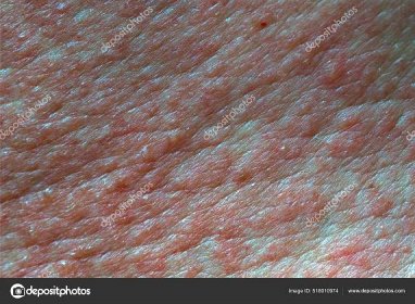 Stáhnout - Kožní textura bolestivá v červených blistrech kožní vyrážky po chemickém popálení — Stock obrázek