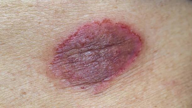 tinea corporis nebo kožní onemocnění. svědění kožních lézí na břiše. - hemangioma - stock snímky, obrázky a fotky
