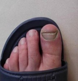Léčba plísní nehtů na nohou v domácích podmínkách octem