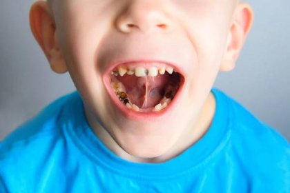 kaz na zubech malého dítěte - zubní kaz - stock snímky, obrázky a fotky