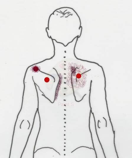 Trigger points - trapéz
