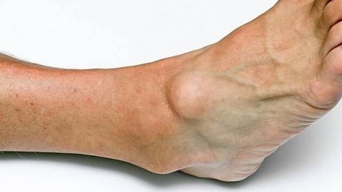 Gangliony se objevují zejména v místech, kde se nachází velké množství vazivové tkáně – především v oblasti zápěstí, dlaní, kotníků či chodidel.