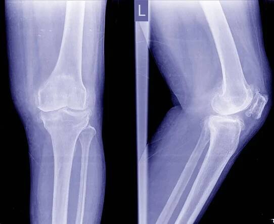 Osteoartróza (Oa) koleno. Film rentgenové Apand boční pohled kolena ukazují úzká kloubní štěrbiny, subchondrální skleróza, osteofytů (spur), zánět kolenního kloubu. — Stock obrázek