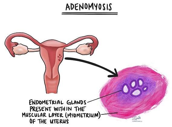 Adenomyóza