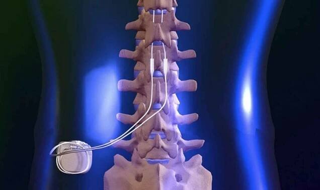 Představení řešení problému s chronickou bolestí pomocí neuromodulační terapie ve Fakultní nemocnici Královské Vinohrady.