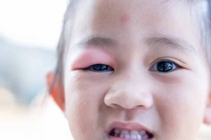 Oční onemocnění. Uzavřené asijské dítě holčička oko s sty, víčko absces ophthalmic hordeolum — Stock obrázek