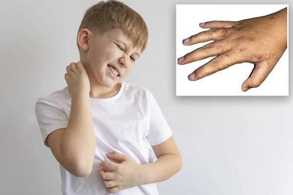 Health professionals in the UK have noted an "alarming" rise in scabies cases there.