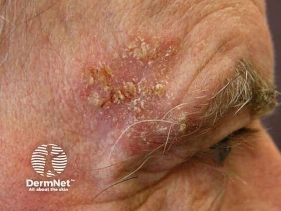 Skin Cancer (Nonmelanoma) | Clinical | Dermatology Times - Dermatology News and Clinical Insights