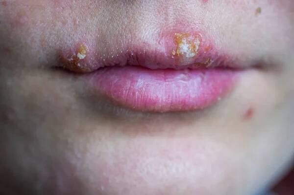 Onemocnění herpes na rtech mladé dívky. Zranění z herpes na rtech člověka. Herpes foci. — Stock obrázek