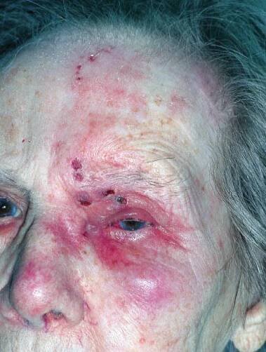 Varicella-zoster vaskulitida