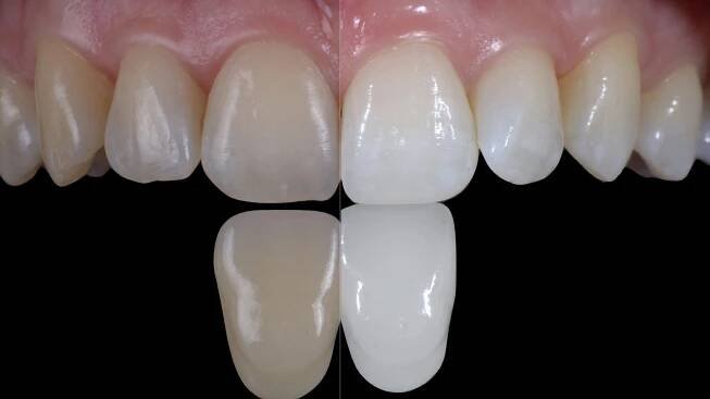 Bleaching - Dentalux