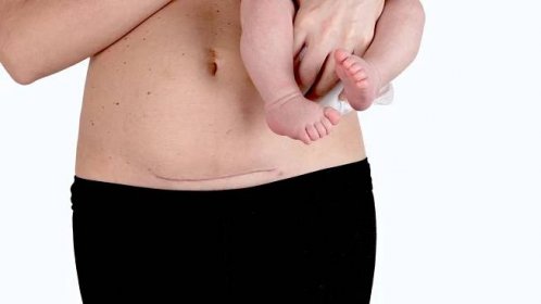 Počet císařských řezů roste. Rozhodující je přitom věk při prvním porodu, říká přední porodník