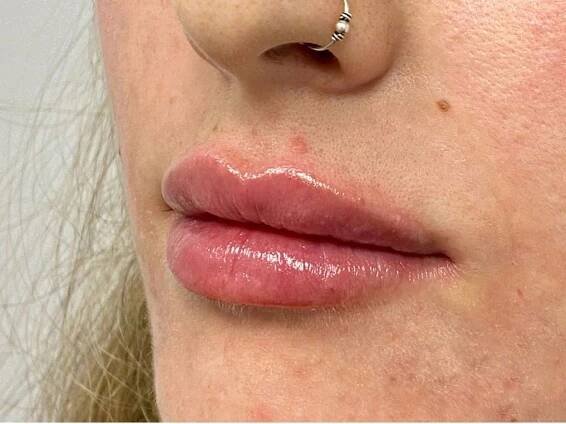 Treatments Hampshire | CS Aesthetic Injector 
