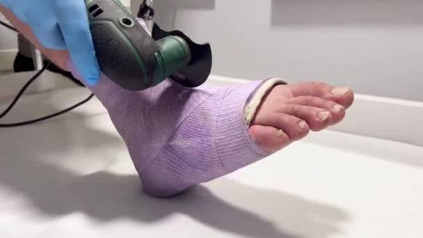 A healthcare worker is carefully cutting through a purple plaster cast on a patients foot with an oscillating cast cutter. It signifies the end of bone healing and recovery. — Stock Footage