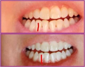 Zuby, zoubky, zubaři | Uštípnutý zub u dospělého