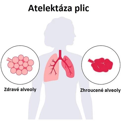 Atelektáza plic - ilustrace