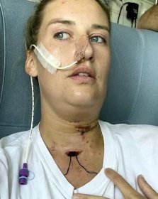 Letušce diagnostikovali rakovinu úst: Chirurgové jí vyřízli kus jazyku! Náhradu vzali z nohy