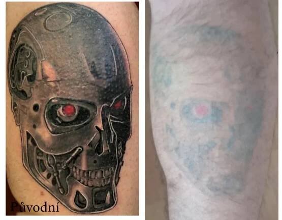 Galerie odstraněných tetování - Filips Tattoo