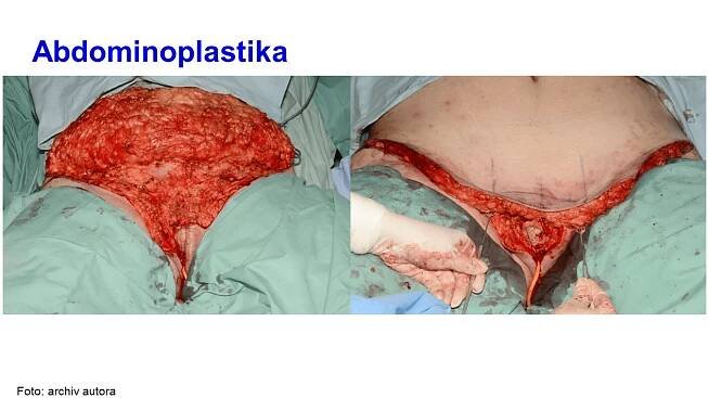 kurz23-chir - HIDRADENITIS.cz