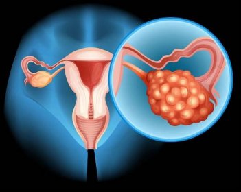 Žádná žena by neměla ignorovat příznaky rakoviny vaječníků. Může na nich záležet váš život