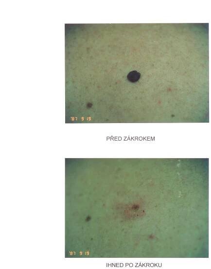 Odstranění pigmentových skvrn a znamének laserem