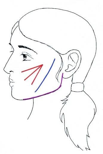 Facelift pomocí nití + video (lifting obličeje a čela) - Zdravé omlazení
