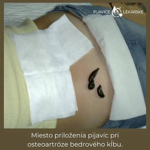 Hirudoterapie a artróza s chronickou bolestí kloubů je kombinace, která poskytne klientovi především úlevu od bolesti a regeneraci.