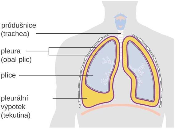 Fluidothorax