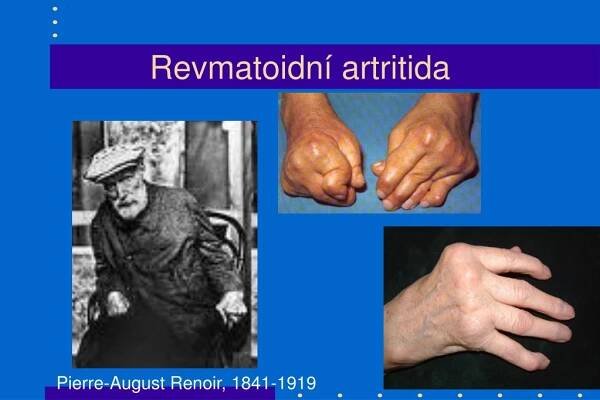 PPT - Imunopatologické reakce PowerPoint Presentation, free download - ID:6183663