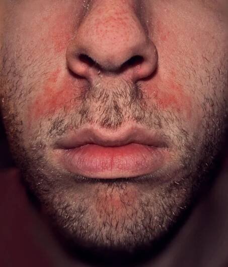 Psoriáza vs dermatitida: Rozdíl a srovnání