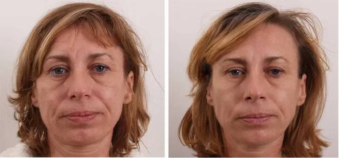 Facelifting a omlazení pokožky obličeje | Slevomat.cz