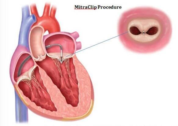 New Study Finds Tiny Clip That Repairs Leaky Heart Valve is a Powerful